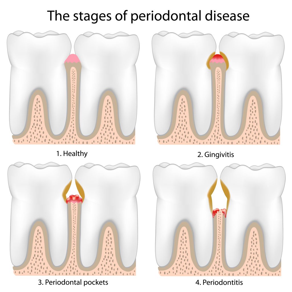 Illustration showing the stages of gum disease