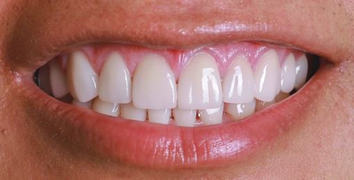 Before & After Smile Makeover Patient 3 after - Inwood Village Dental