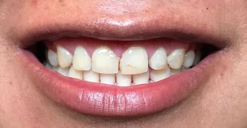 Before & After Smile Makeover Patient 3 before - Inwood Village Dental