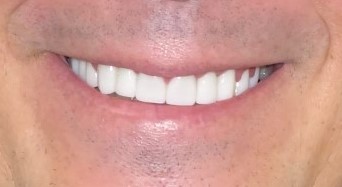 Before & After Smile Makeover Patient 6 after- Inwood Village Dental