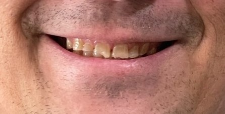 Before & After Smile Makeover Patient 6 before- Inwood Village Dental