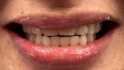 Before & After Smile Makeover Patient 1 before- Inwood Village Dental