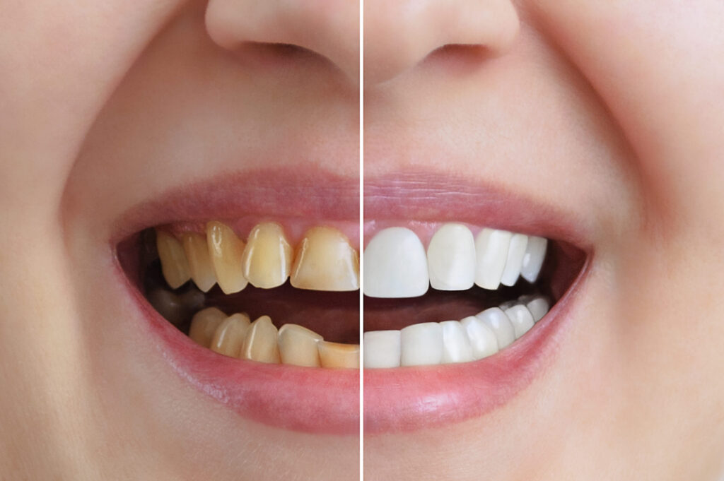 Before & After Smile Makeover - Inwood Village Dental
