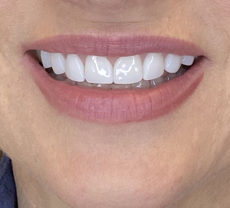 Before & After Smile Makeover Patient 7 after- Inwood Village Dental