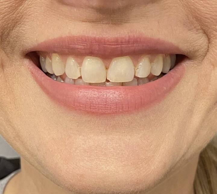 Before & After Smile Makeover Patient 7 before- Inwood Village Dental